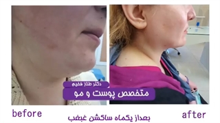بعداز یکماه ساکشن غبغب