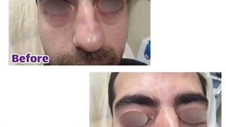 تزریق ژل زیر چشم برای رفع تیرگى و گودى زیر چشم