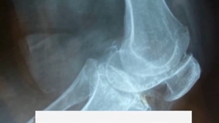 جراحىTKAتعویض مفصل کامل زانو خانم 75 ساله