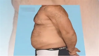جراحی همزمان ابدومینوپلاستی و ژنیکوماستی گرید ۳ در آقای جوان با کاهش وزن زیاد