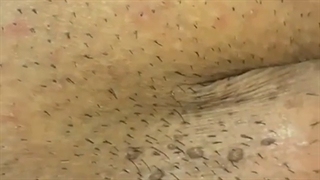 بهترین راه درمان زگیل تناسلی