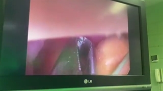 درمان سنگ مثانه به روش بسته