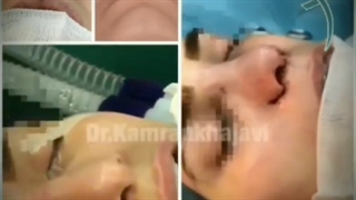 جراحی زیبایی بینی