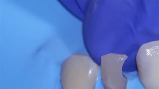 ترمیم پوسیدگی دندان