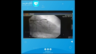 آنژیوپلاستی اورژانسی در رگ بیمار