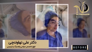 فیلم واقعی لیفت ابرو و گوشه چشم بدون جراحی