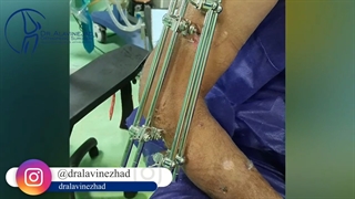 شکستگی خرد شده ارنج به دنبال اصابت گلوله