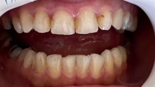 نتیجه 16 واحد کامپوزیت دندان