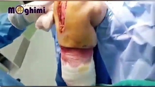 فیلم بدون سانسور تعویض مفصل زانوی راست - پارت دوم