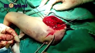 فیلم بدون سانسور جراحی شکستگی و در رفتگی آرنج