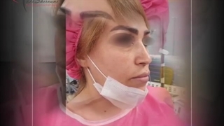 فیلم قبل و بعد جراحی زیبایی بینی