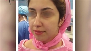 فیلم جراحی بینی با انحراف شدید، از قبل تا یک ماه بعد