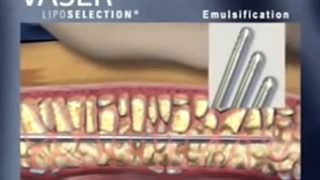 جدیدترین روش پیکر تراشی