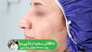 تزریق چربی به صورت | دکتر سمیه زمانی نیا زیبایی پوست