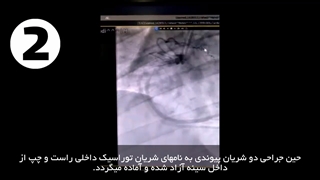 جراحی بای پس کرونر با پیوند شریان