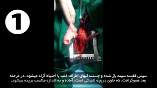 جراحی کارگذاری دریچه ریوی