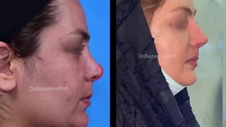 جراحی ترمیمی بینی برای افزایش طول و اصلاح کجی بینی | دکتر باستانی نژاد