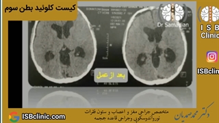 کیست کلوئید بطن سوم