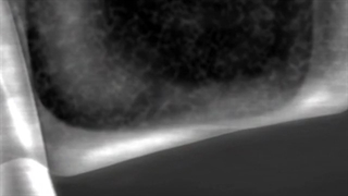 لیفت سینوس | کلینیک تخصصی دندانپزشکی کانسپتا