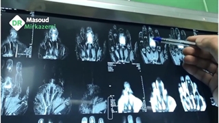 فیلم واقعی خارج کردن تومور انگشت
