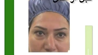 جراحی افتادگی پلک بالا و پایین