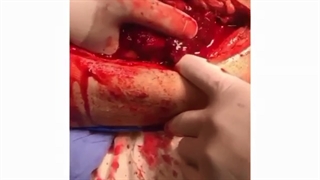 جراحی بازسازی مجدد تومور مولتیپل میلوما ران