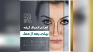 اصلاح انحراف تیعه بینی بعد از جراحی