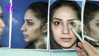 فیلم جراحی زیبایی بینی در اتاق عمل
