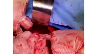 فیلم خارج کردن توده بزرگ رحمی با جراحی