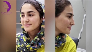 فیلم واقعی جراحی تیپ پلاستی و برداشتن قوز بینی، بدون بیهوشی