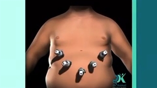 فیلم جراحی بای پس معده