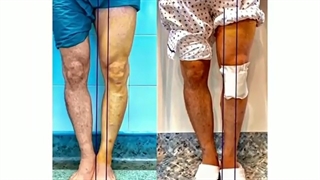 جراحی زانوی پرانتزی