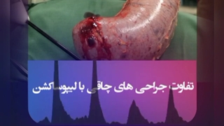 تفاوت جراحی های چاقی با لیپوساکشن