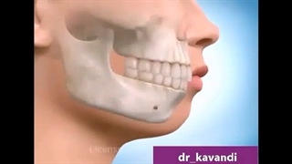 جراحی جلو آوردن چانه