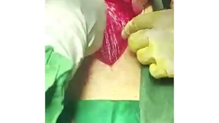 جراحی توده تخمدان