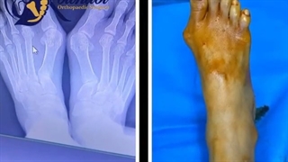 جراحى هالوکس والگوس شدید با پلاک مینی