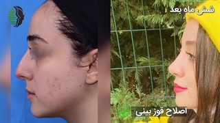 شش ماه بعد از جراحی بینی با پوست مناسب | دکتر باستانی نژاد
