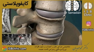 کایفوپلاستی