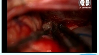 جراحی مننژیوم قاعده جمجمه (توبرکولوم سلا)