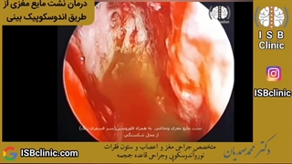 ترمیم نشت مایع مغزی و نخاعی به روش اندوسکوپیک از راه بینی