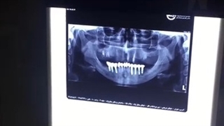 کاشت 8 واحد ایمپلنت دندان در یک جلسه بصورت همزمان با کشیدن و تقویت استخوان