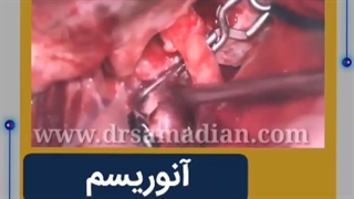 عمل جراحی کلیپ آنوریسم افتالمیک شریان داخلی چپ