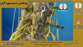 برداشتن جسم مهره گردن