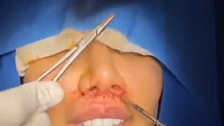 جراحی سانترال لب | دکتر شبنم شادابی