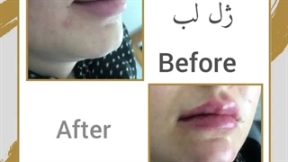 تزریق ژل به لب