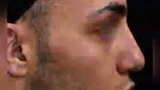 جراحی بینی گوشتی و انحراف بسیار شدید سپتوم از دکتر ماریا مرادی