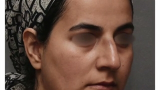 نتیجه جراحی زیبایی بینی