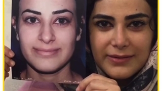 عمل زیبایی بینی