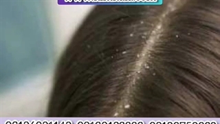 قوی ترین شامپو ضد شوره/۰۹۱۲۰۷۵۰۹۳۲/ضد شوره قوی