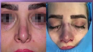 قبل و بعد از جراحی زیبایی بینی | دکتر رفیع | جراح پلاستیک